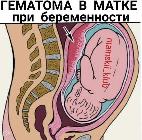 Гематома при беременности как долго будет выходить