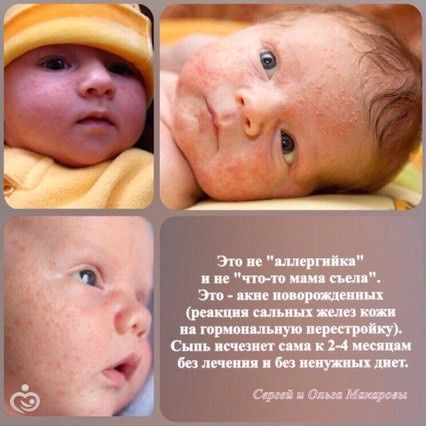 Гормональная сыпь новорожденных у кого было Гормональная сыпь новорожденных у кого было