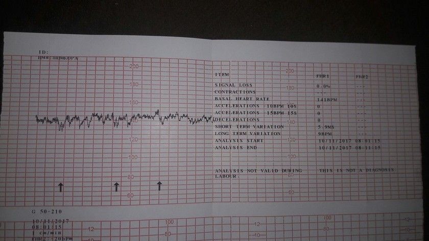 КТГ (фото) помогите понять(