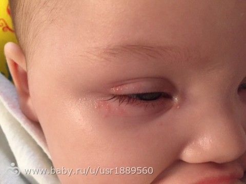Сыпь вокруг глаз у ребенка фото с пояснениями и Сыпь вокруг глаз у ребенка фото с пояснениями и