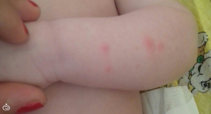 международное аллергия на комариные укусы подался назад