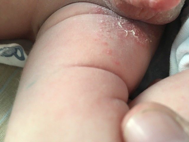 красные щеки аллергия на памперсы