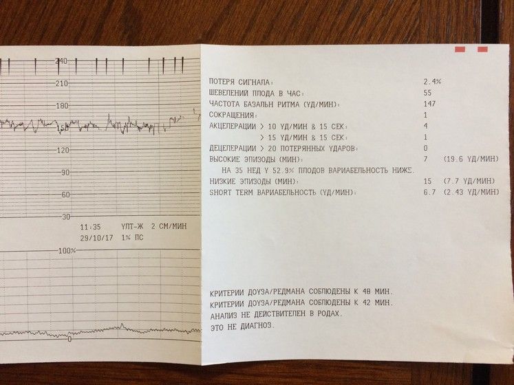 Первые шевеления плода при беременности форум. КТГ по критериям Доуза-Редмана. Критерии Доуза Редмана КТГ. Шевеления плода на КТГ. Норма шевелений на КТГ.